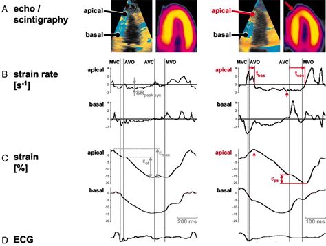 systolic load vs myocardial shortening